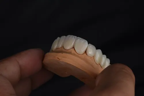 Veneers.webp