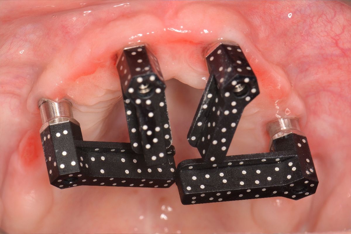 photogrammetry_in_full_arch_implant_treatment_portland_perio_implant.jpg