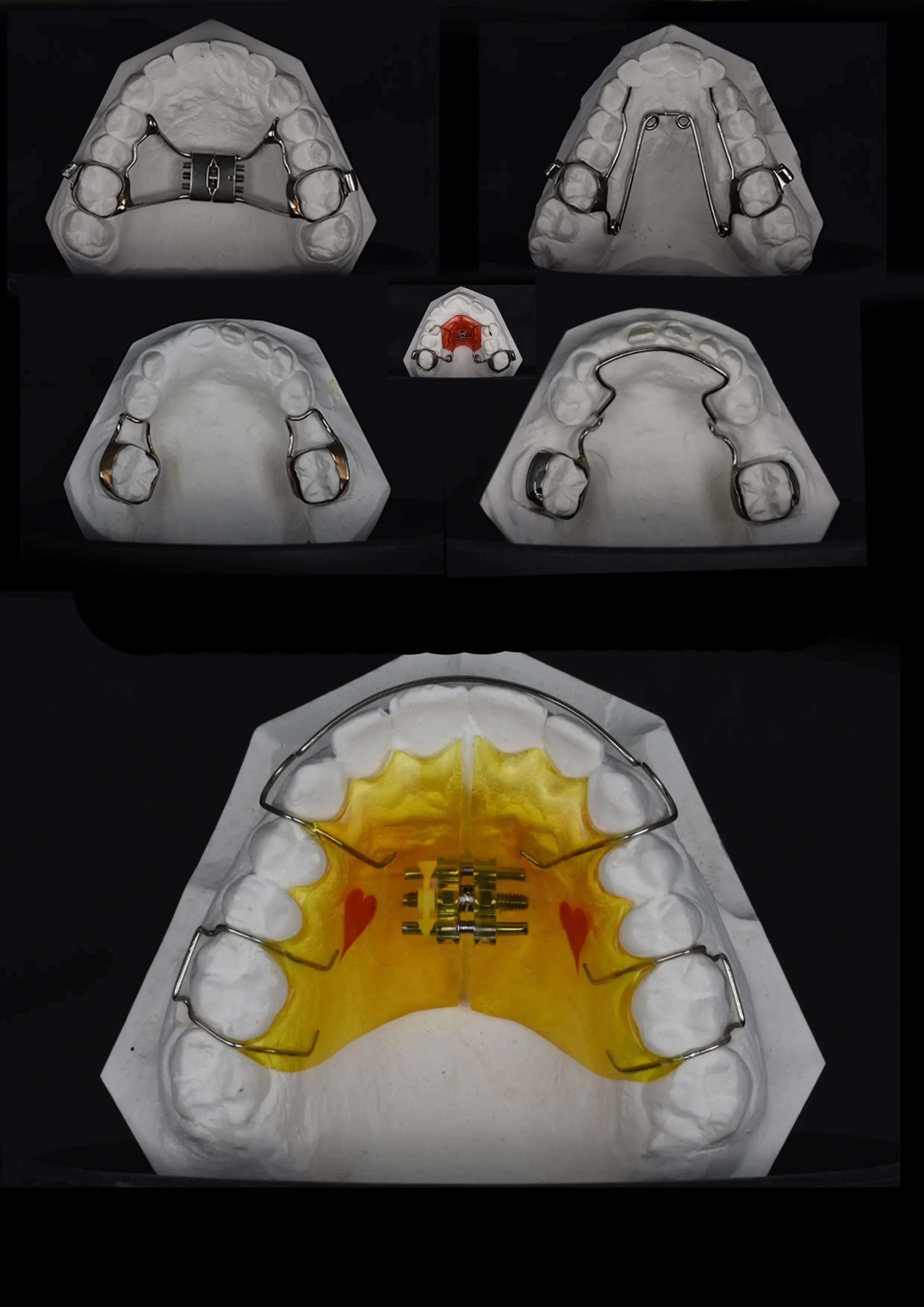 removable appliance.webp
